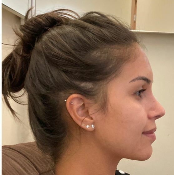 After rhinoplasty
