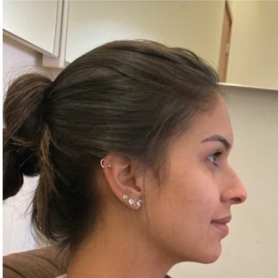 Before rhinoplasty